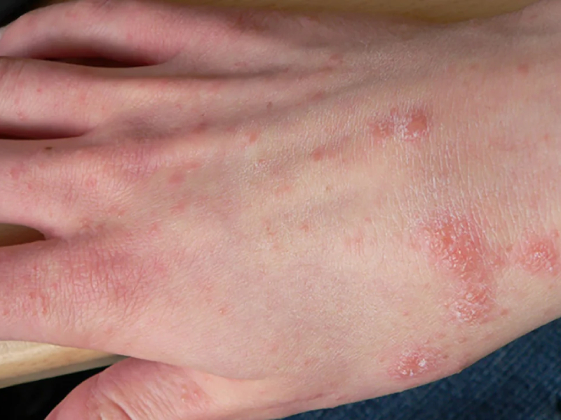 scabies symptoms caused by mites 