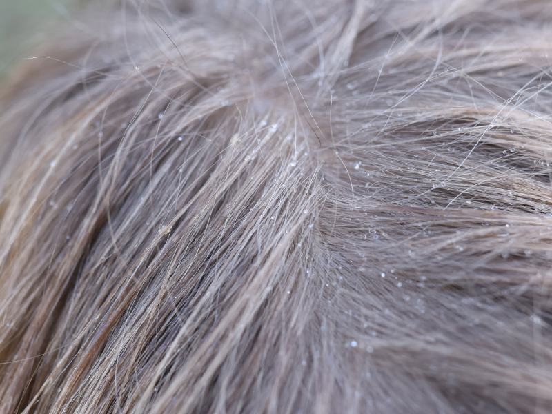 Dandruff reduction scalp massage benefit