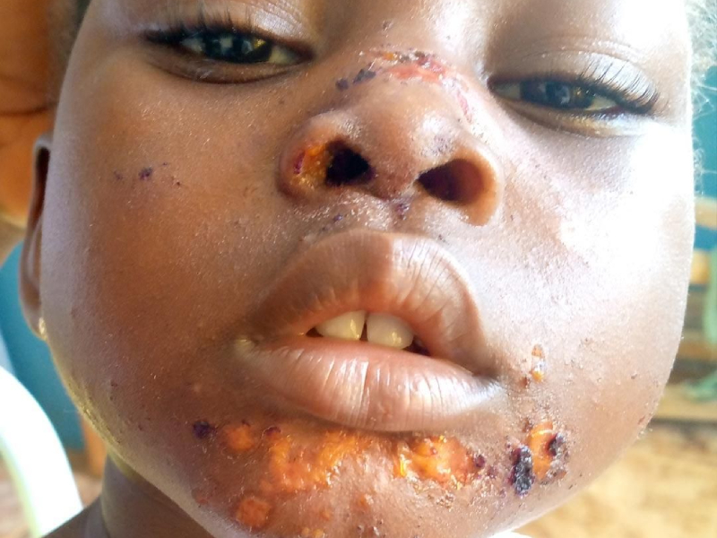 Understanding Impetigo infection