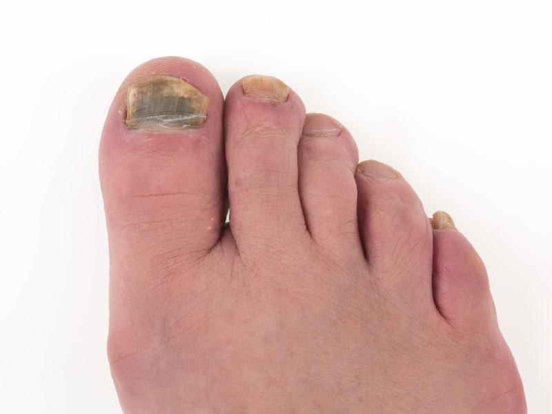 Causes of Toenail Fungus