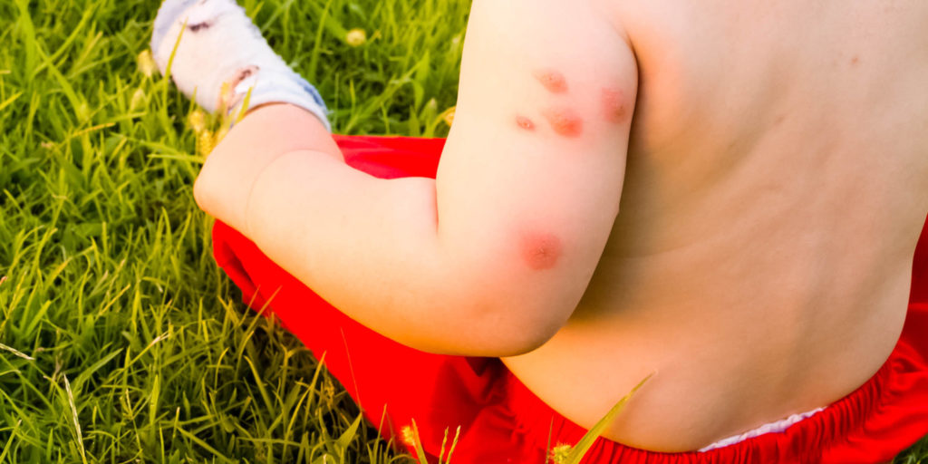 What are mosquito bites