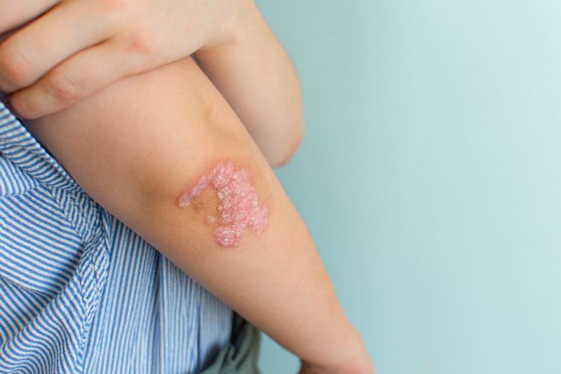 What is eczema