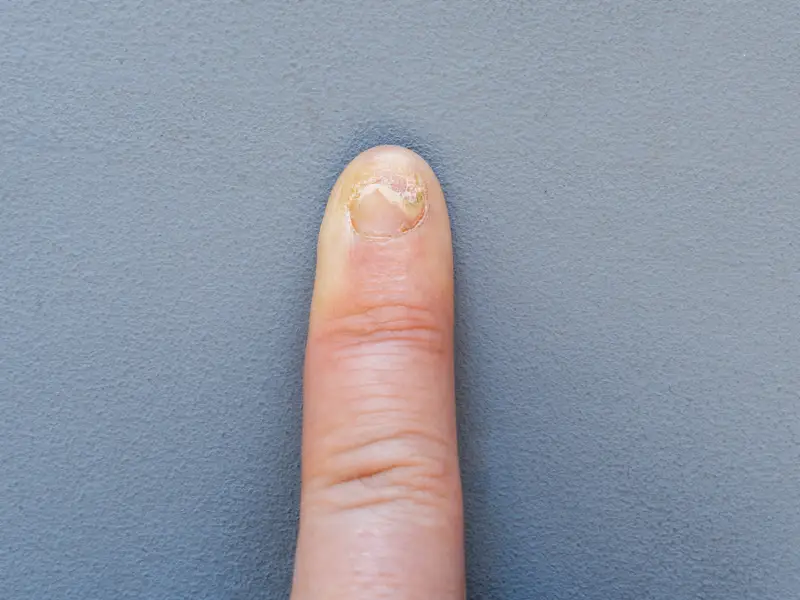Nail fungus vs. nail psoriasis
