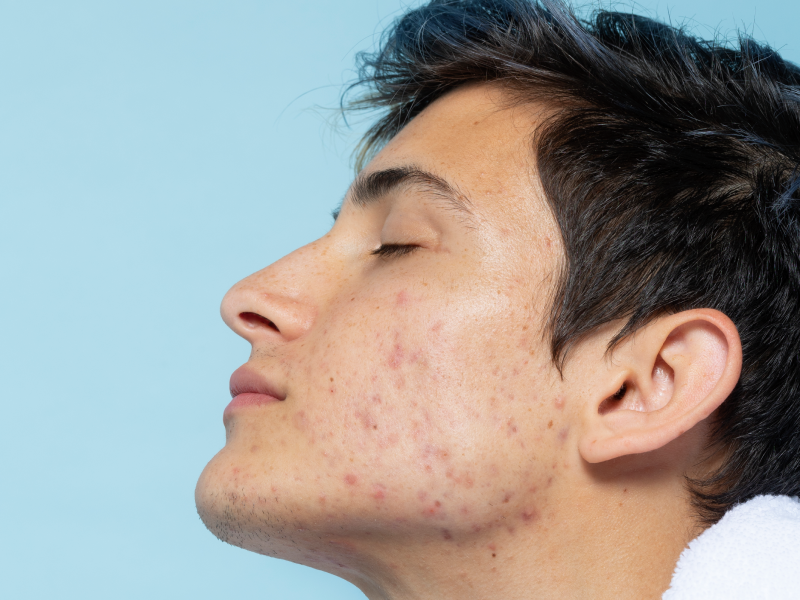 Cystic acne is a severe form of acne