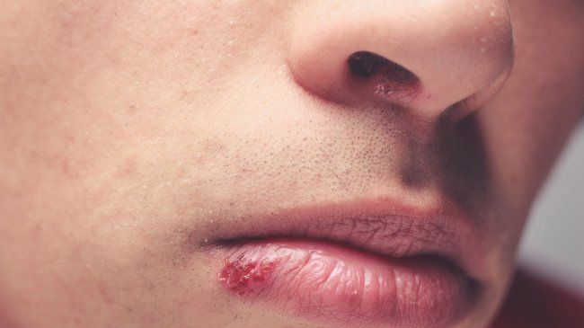 what is cold sore