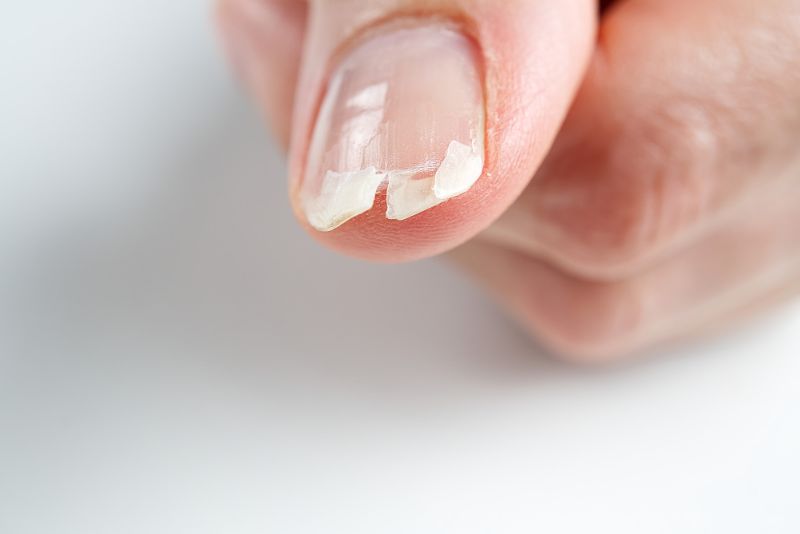 white spots on nails by trauma