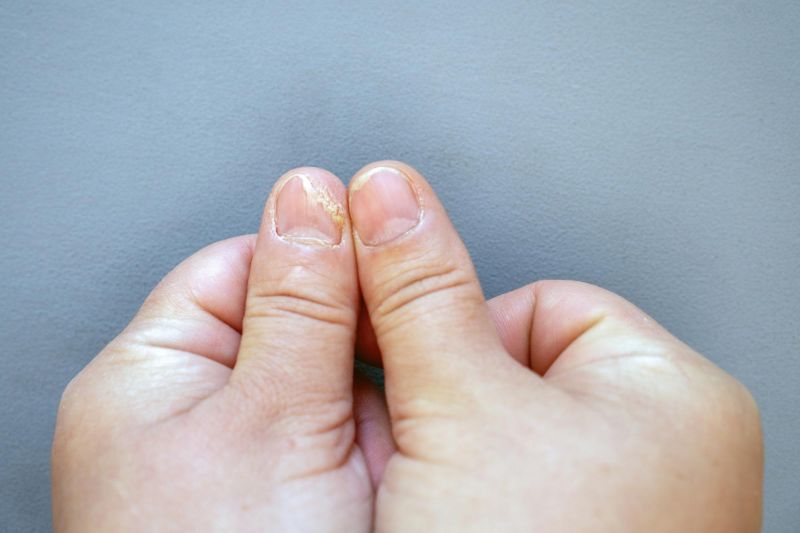 white spots on nails fungal infection