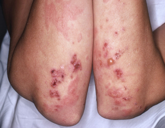 Blisters by Dermatitis herpetiformis