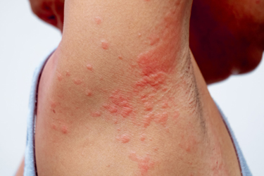 Contact Dermatitis causes of blisters