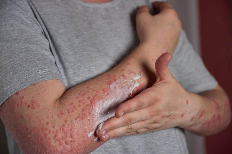 Moisturizing treating psoriasis at home