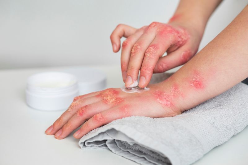 Psoriasis causes red scaly patches