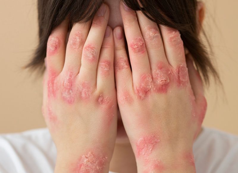 Psoriasis is a common skin condition