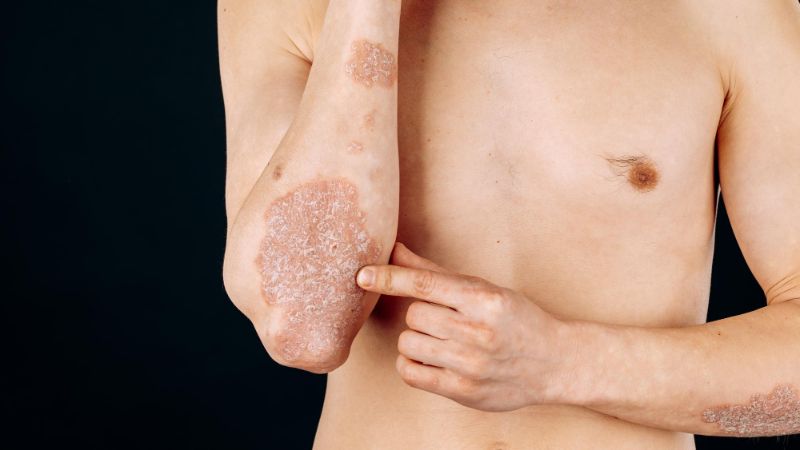 Psoriasis skin condition