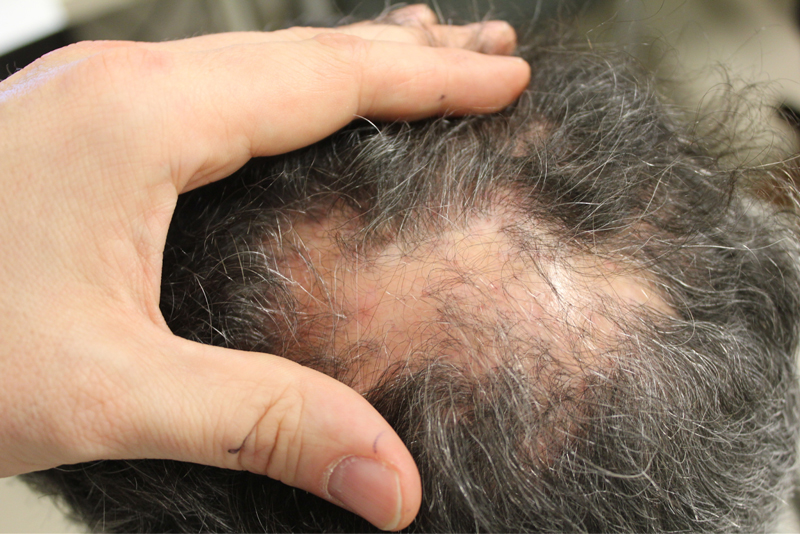 Symptoms of Lichen Planopilaris