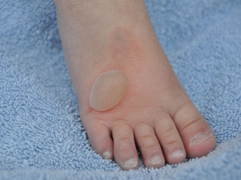 The Significance of Blisters
