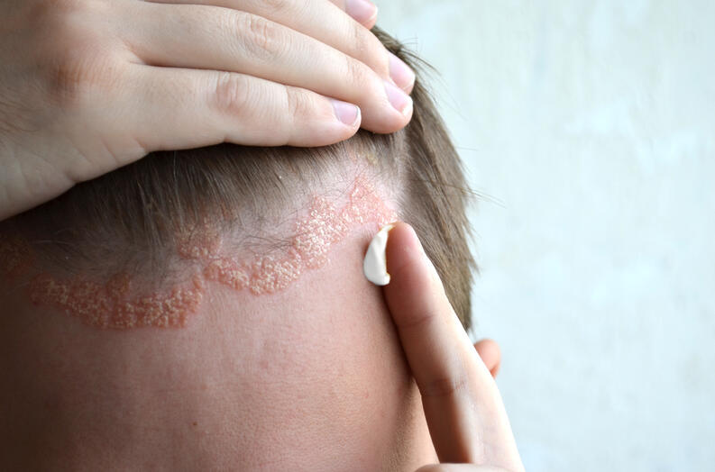 seborrheic dermatitis treatment Topical Corticosteroids