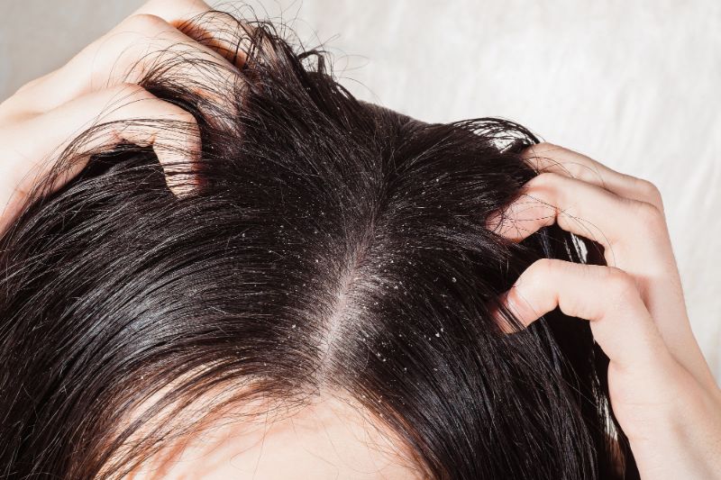 types of scalp dandruff