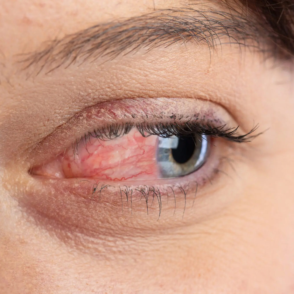 Ocular Rosacea