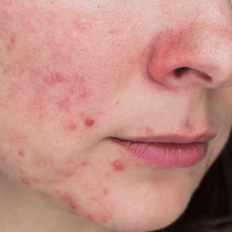 Papulopustular Rosacea