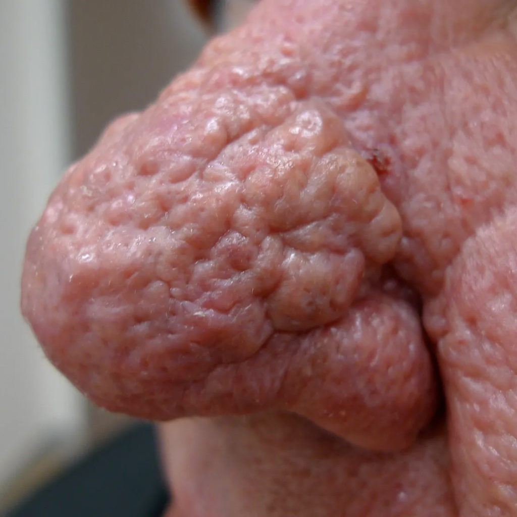 Understanding Phymatous Rosacea