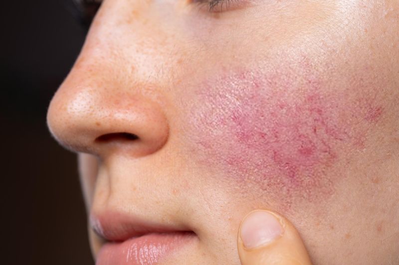 Winter Rosacea in Canada
