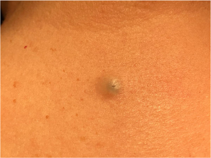 epidermal inclusion cyst 