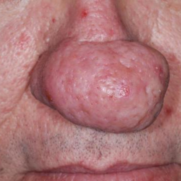 Phymatous Rosacea
