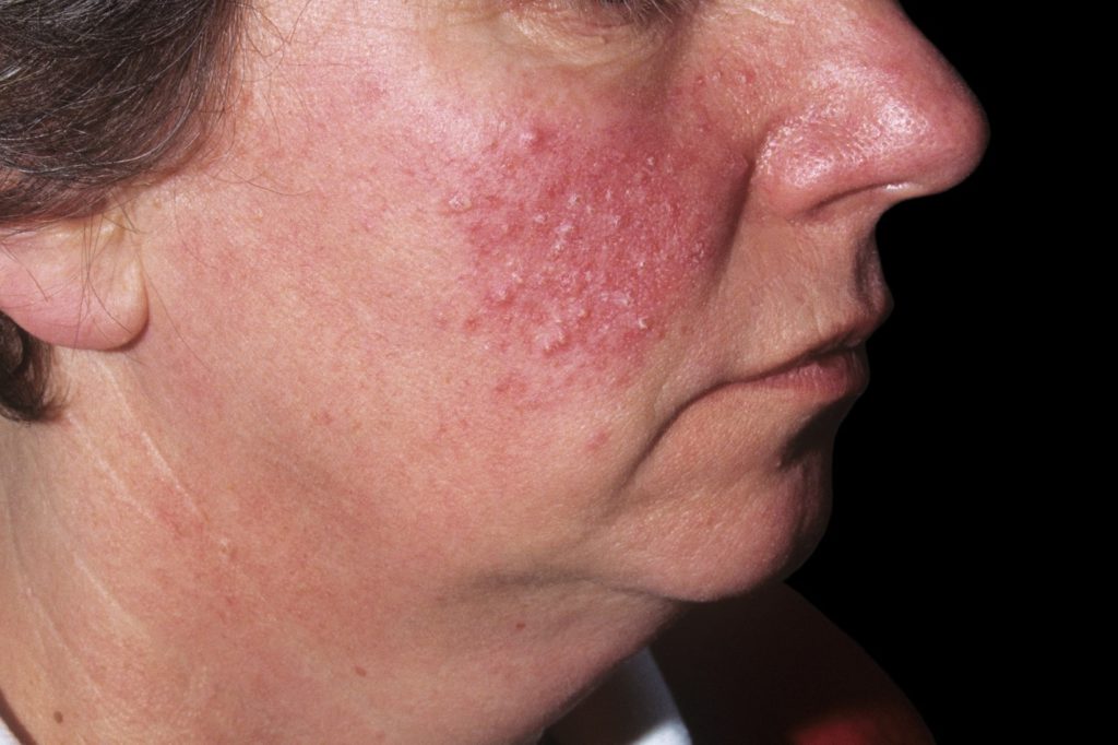 Symptoms of Papulopustular Rosacea