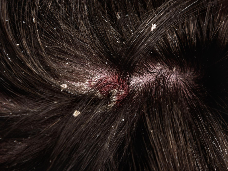 Contact Dermatitis or scalp eczema