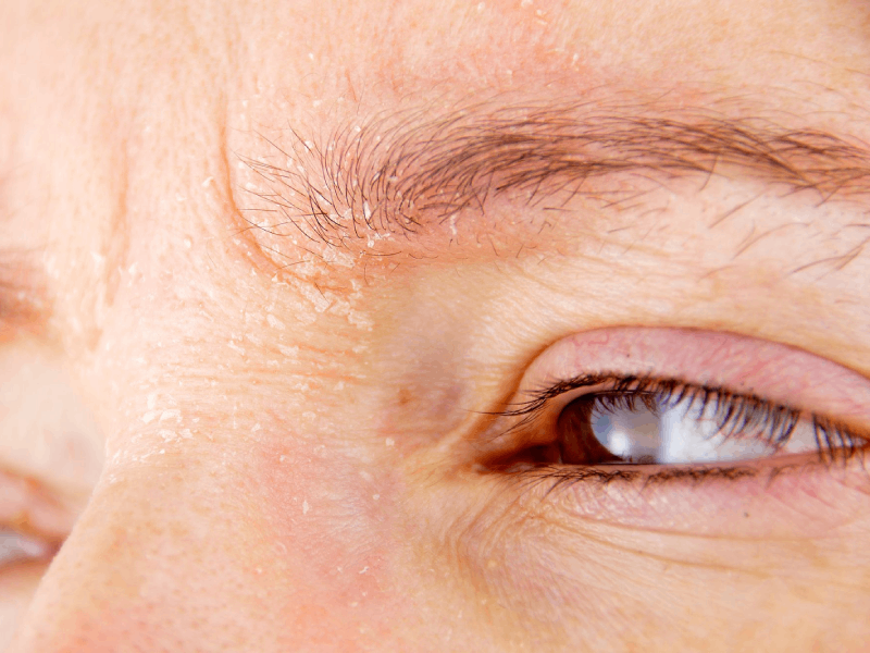 seborrheic dermatitis eyebrow dandruff