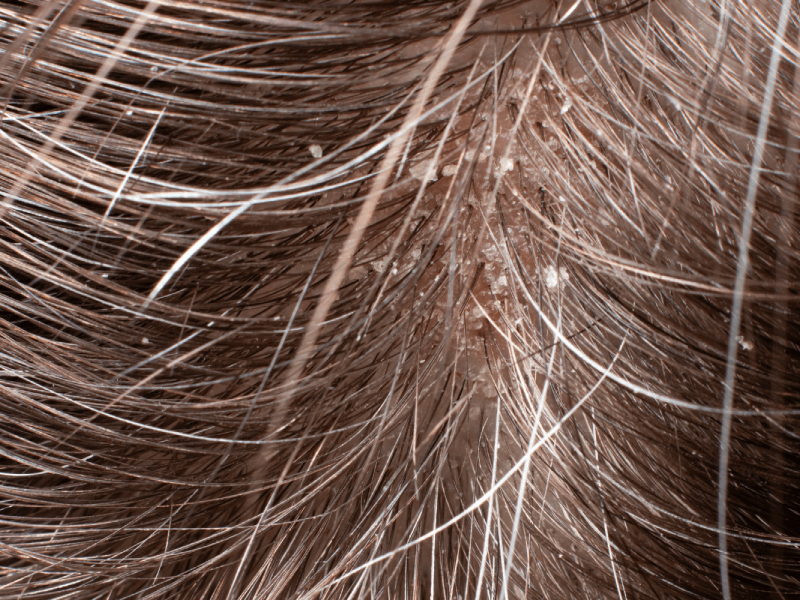 Scalp vs. eyebrow dandruff