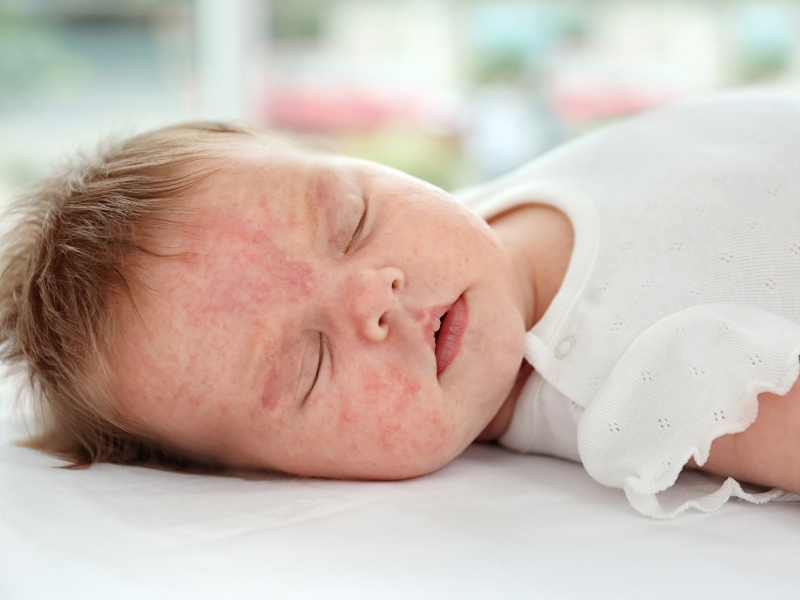 Does Baby Eczema Hurt