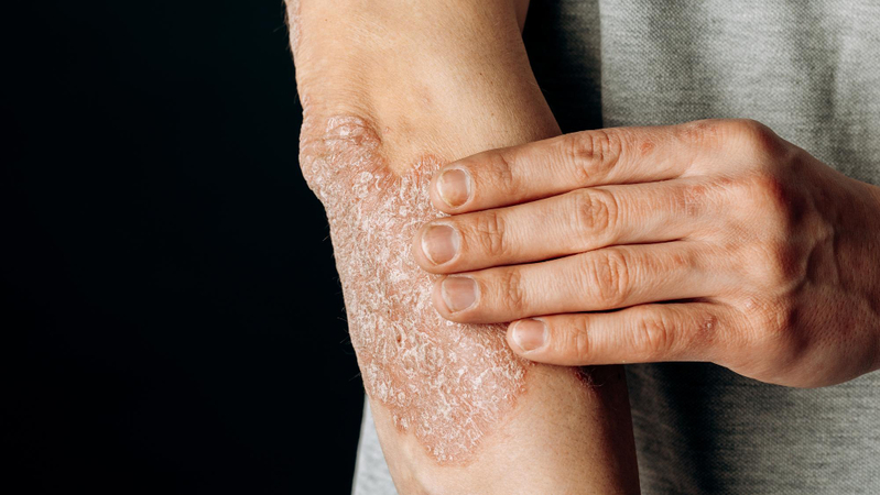 Common eczema symptoms