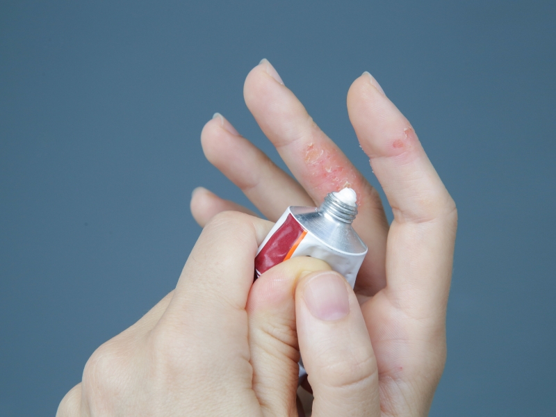 Moisturize seasonal eczema