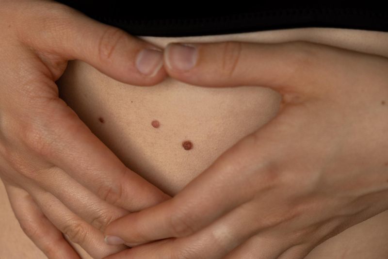 Skin cancer common symptoms