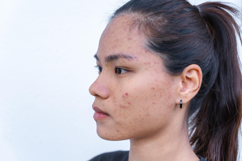 What Causes Acne Vulgaris