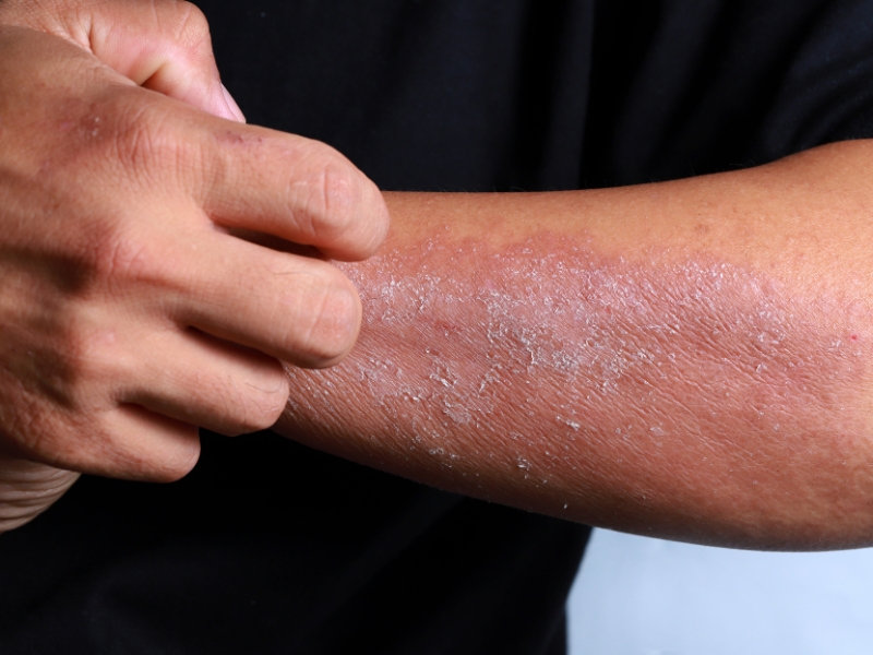 Why Does Eczema Hurt So Much