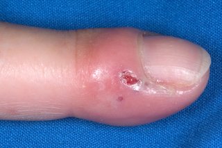 herpetic whitlow symptoms