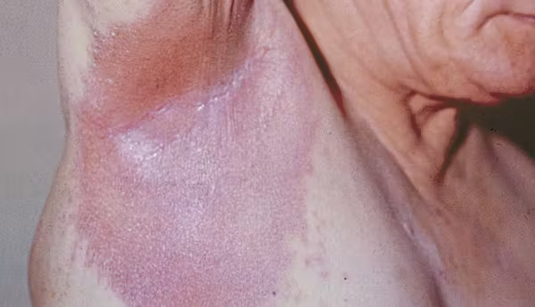 Inverse psoriasis symptoms