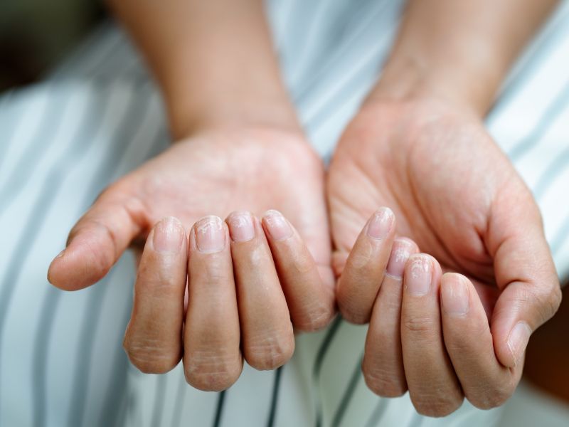 Brittle Nails Symptoms 