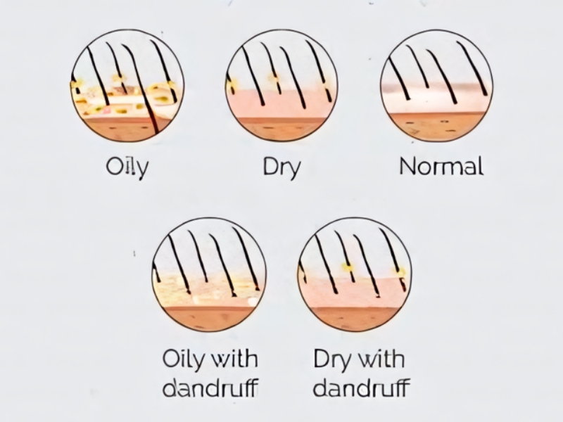 Different types of scalp