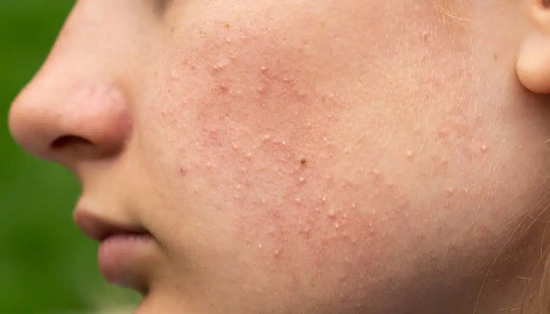 Fungal acne or Malassezia folliculitis