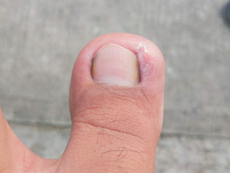 Ingrown Toenail symptoms