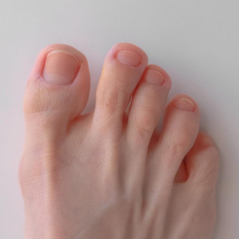 Ingrown toenail prevention