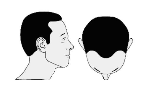 M-shaped hairline 