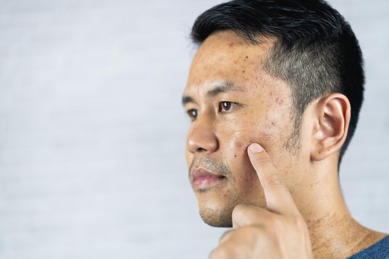 Male Hormones effect on acne