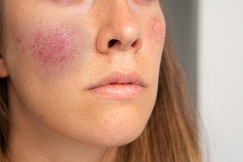 Mild rosacea causes