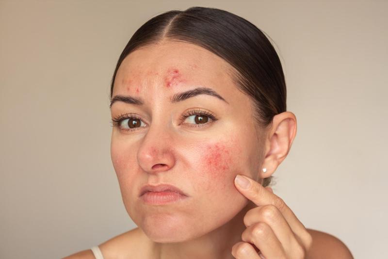 Online Rosacea Treatment