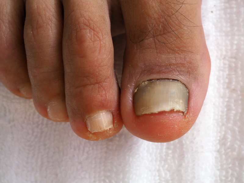 Onychomycosis a nail matrix disease