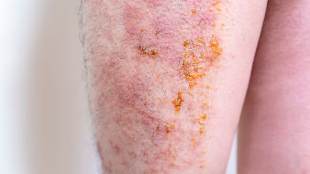 Weeping Eczema Appearance